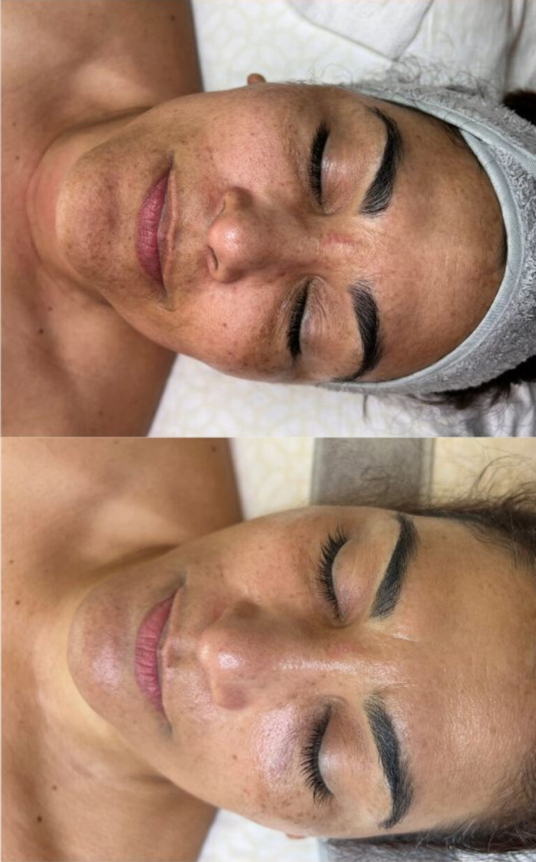 Revitalización facial Revitalización facial