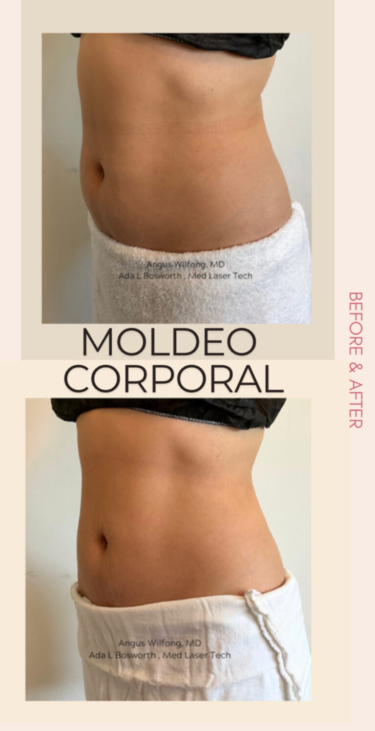 Moldeo corporal Moldeo corporal
