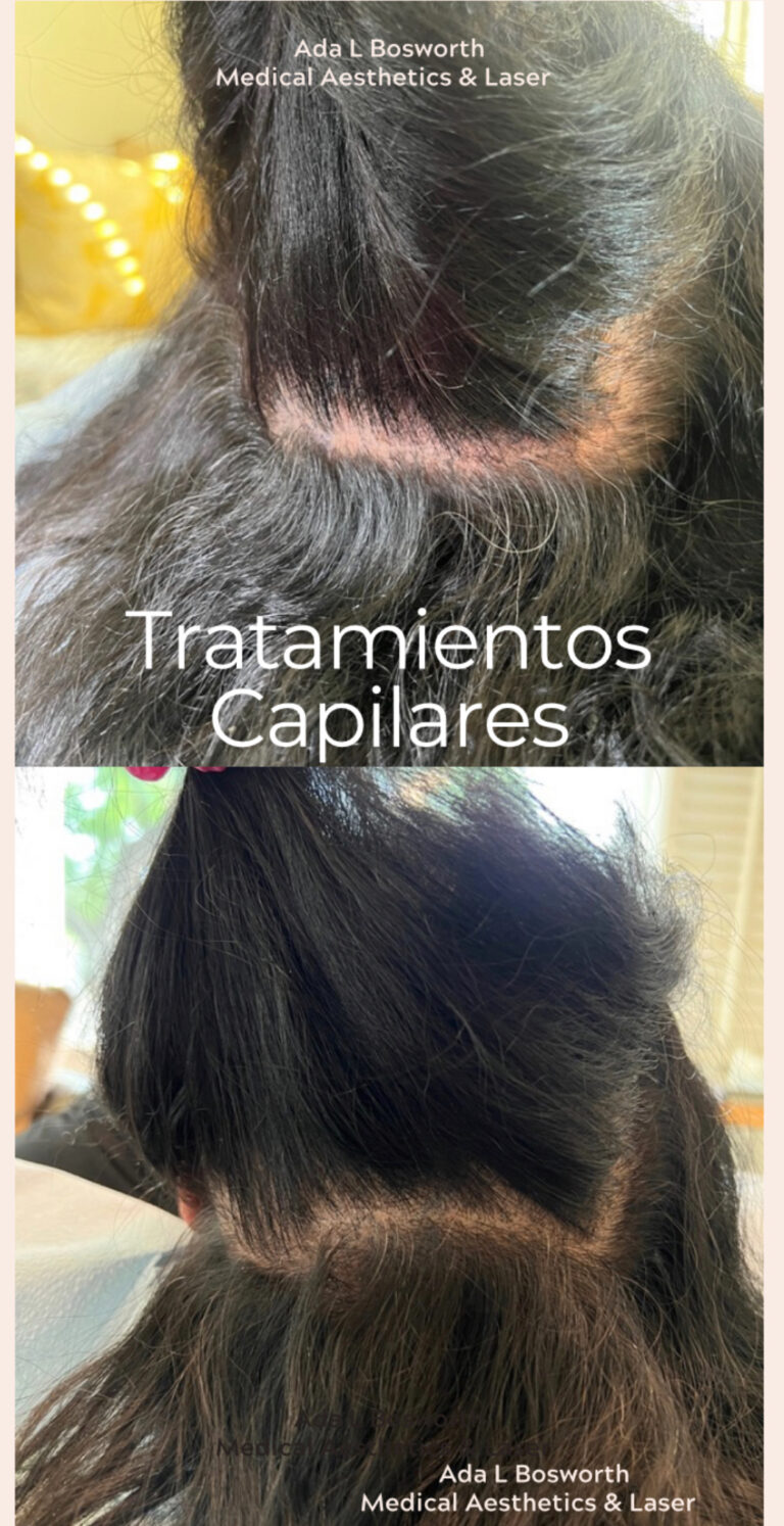 Tratamiento capilar Tratamiento capilar