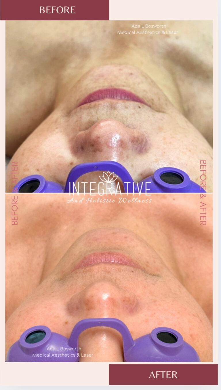 Tratamiento IPL/Photo facial Tratamiento IPL/Photo facial