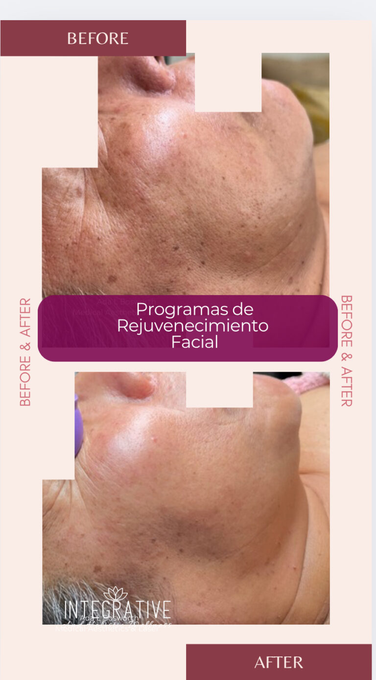Programa de rejuvenecimiento facial Programa de rejuvenecimiento facial