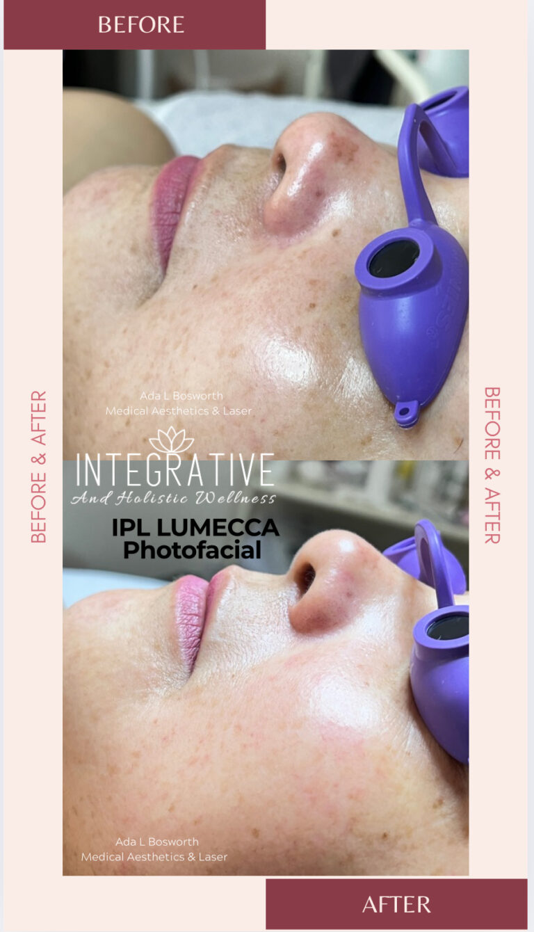 Foto facial / IPL Foto facial / IPL