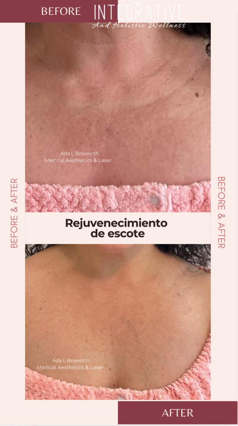 Rejuvenecimiento de escote Rejuvenecimiento de escote