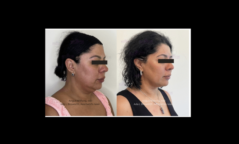Perfilado facial Perfilado facial